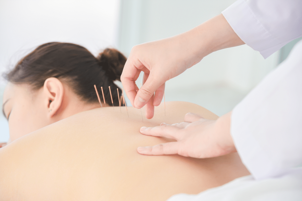 My Journey with Acupuncture for CIRS